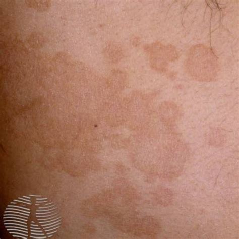 dark spots on skin fungus